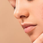 Acne Treatment in Dubai: Cost, Results, and Recovery Explained