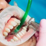 5 Surprising Benefits of Regular Teeth Cleaning in Marietta
