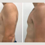 Best Gynecomastia Doctors in Dubai Expert Surgeons for Male Chest Reduction