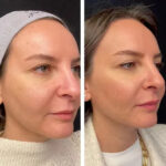 Mesotherapy in Dubai – Anti-Aging Results Without Surgery