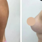 Best Breast Reduction Surgeons in dubai for Reduced Discomfort