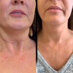 Skin Starts New with Profhilo Treatments in Dubai