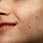 Types of Pigmentation: How to Identify What You Have