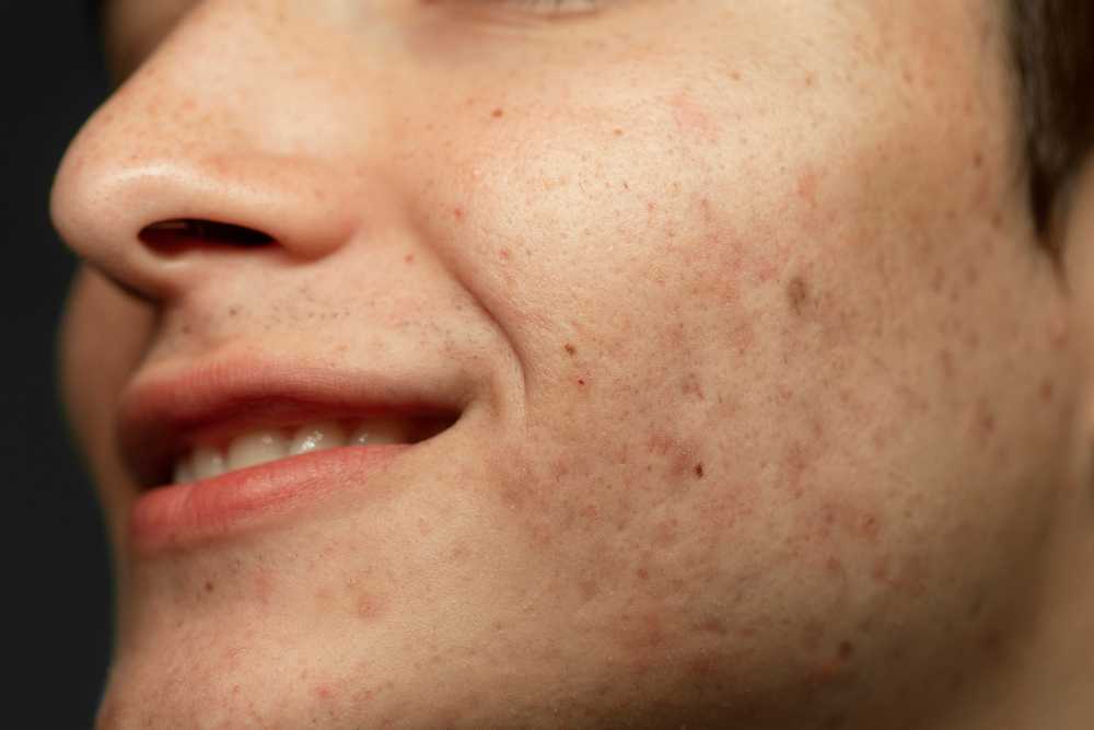 Types of Pigmentation: How to Identify What You Have