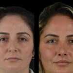 How Cheek Fillers Improved Best Doctors in Dubai Confidence