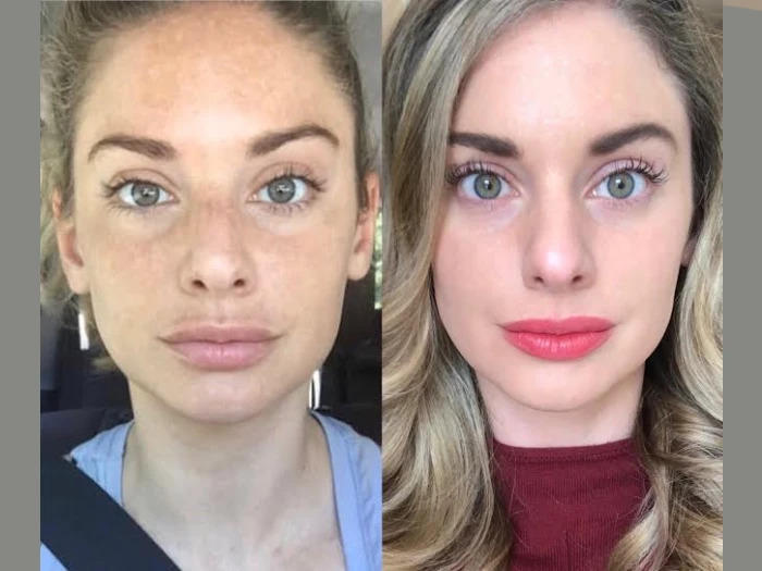 Clear Skin with Radiofrequency (RF) Microneedling Best Doctors in Dubai