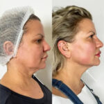 How the Best Aesthetic Clinics in Dubai Use Endolift to Sculpt the Perfect Jawline