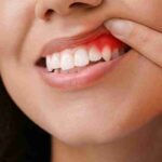 Managing Gum Bleeding During Braces Huntingdon