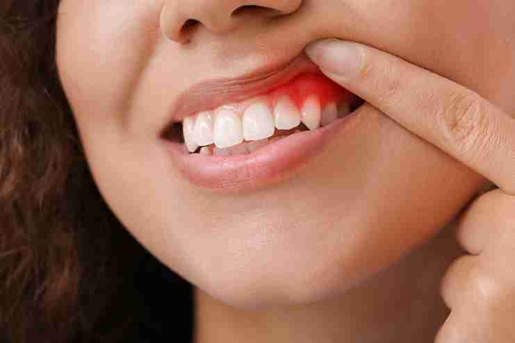 Managing Gum Bleeding During Braces Huntingdon