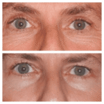 Eye Bag Removal for Asian Skin: Best Doctors in Dubai Share Insights