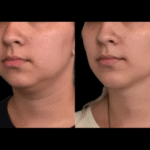 Pain-Free Double Chin Removal: Best Doctors in Dubai Share the Secrets