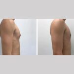 Gynecomastia in Dubai: Safe, Effective, and Proven Treatments