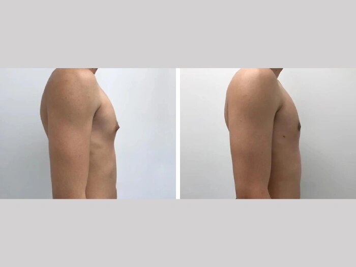 Gynecomastia in Dubai: Safe, Effective, and Proven Treatments