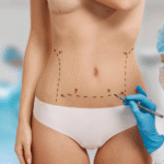 Liposuction vs. Non-Surgical Fat Reduction: Which Is Right for You?