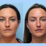 Long-Lasting Effects Thread Lift Treatments in Dubai