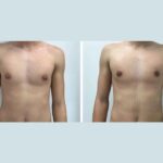 Experience Life-Changing Results with Gynecomastia Surgery in dubai