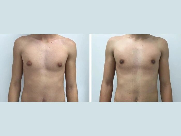 Experience Life-Changing Results with Gynecomastia Surgery in dubai