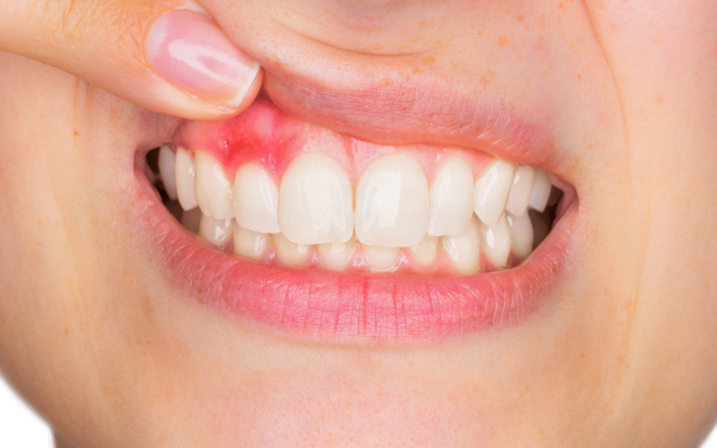Gingivitis: Symptoms & How To Treat It