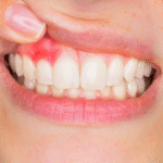 Gingivitis: Symptoms & How To Treat It
