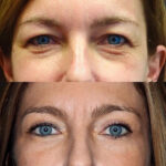 Blepharoplasty in Dubai for Medical vs. Cosmetic Reasons: Key Differences