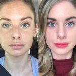 Radiofrequency (RF) Microneedling in Dubai for Pigmentation Correction