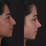 Nose Deviated Septum Surgery in Dubai: A Step Toward Healthy Breathing