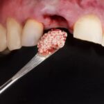 Bone Grafting & Gum Disease Treatment in Diamond Bar | Best Dentist in Diamond Bar CA