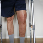 Before & After Knee Replacement in Jaipur: Patient Journey Explained