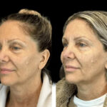 How Best Aesthetic Clinics in Dubai Personalize Botox for Different Age Groups