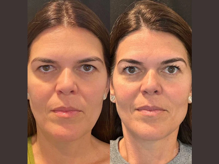 Thread Lift in Dubai: How It Enhances Facial Contours Naturally