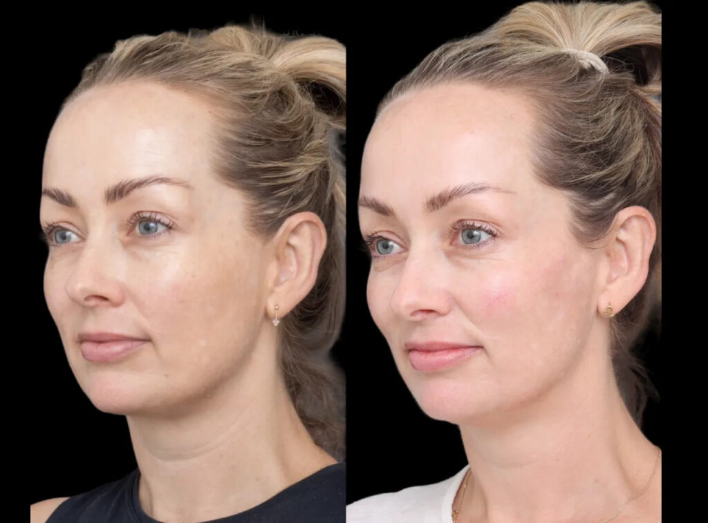 Cheek Fillers Performed by the Best Plastic Surgeon in Dubai