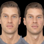 Under Eye Fillers Consultation Process with the Best Plastic Surgeon in Dubai