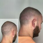 Scar Camouflage Tattoos vs. Traditional Methods: Which Is Right for You?