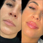 Trusted Specialists for Dermal Fillers Treatment in Dubai