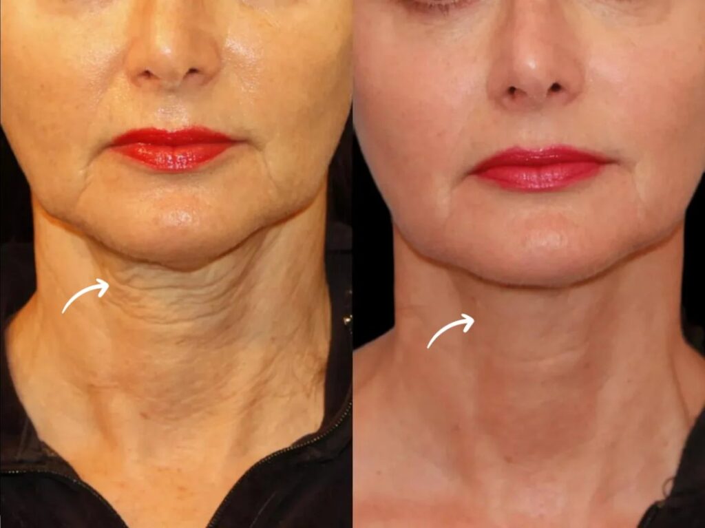Best Doctors in Dubai for Bio-Active Sculptra Lift