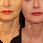 Best Doctors in Dubai for Bio-Active Sculptra Lift