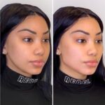 Best Doctors in Dubai for Thread Lift Safe Cosmetic Solutions