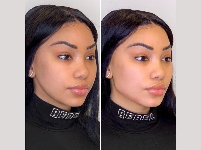 Best Doctors in Dubai for Thread Lift Safe Cosmetic Solutions