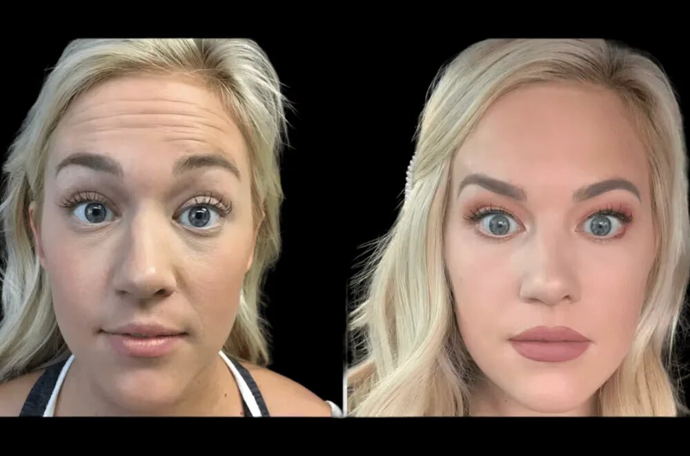 How the Best Aesthetic Clinic in Dubai Ensures Natural-Looking Botox Results