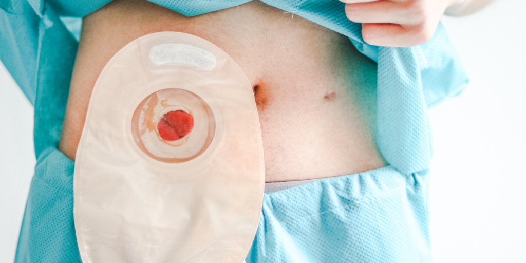 How to Build Confidence While Managing a Colostomy at Home