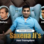 Celebrity Hair Transplants: What Patients Can Learn From Them