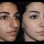 Best Septoplasty Surgeon in Dubai Delivering Trusted Care