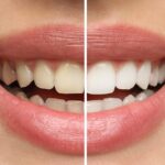 Beyond the Tar: How Professional Teeth Cleaning Can Restore Your Smile