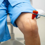 Advanced Knee Arthroscopy in Jaipur for Faster Pain Relief