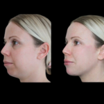 Jawline Fillers for Masculine Features: Best Doctors in Dubai Guide