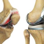 Ligament Injury Treatment in Jaipur: Causes, Symptoms & Best Treatment Options