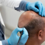 Dr Pauls Multispeciality Clinic – Trusted Destination for Hair Transplant in Kolkata