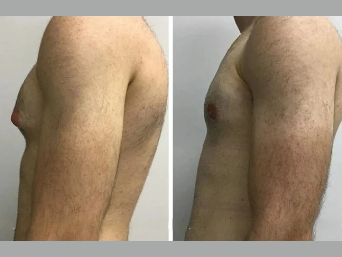 Top Gynecomastia Surgery Techniques Used by Best Gynecomastia Surgeon in Dubai