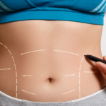 Comprehensive Guide to Abdominoplasty in Jeddah