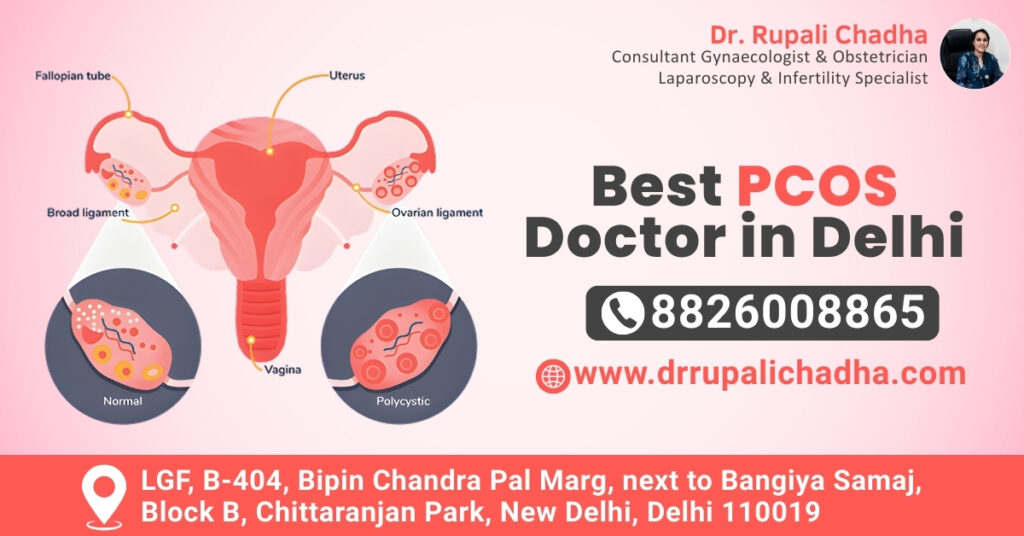 Best PCOS Doctor in Delhi: Hope and Healing for Hormonal Balance